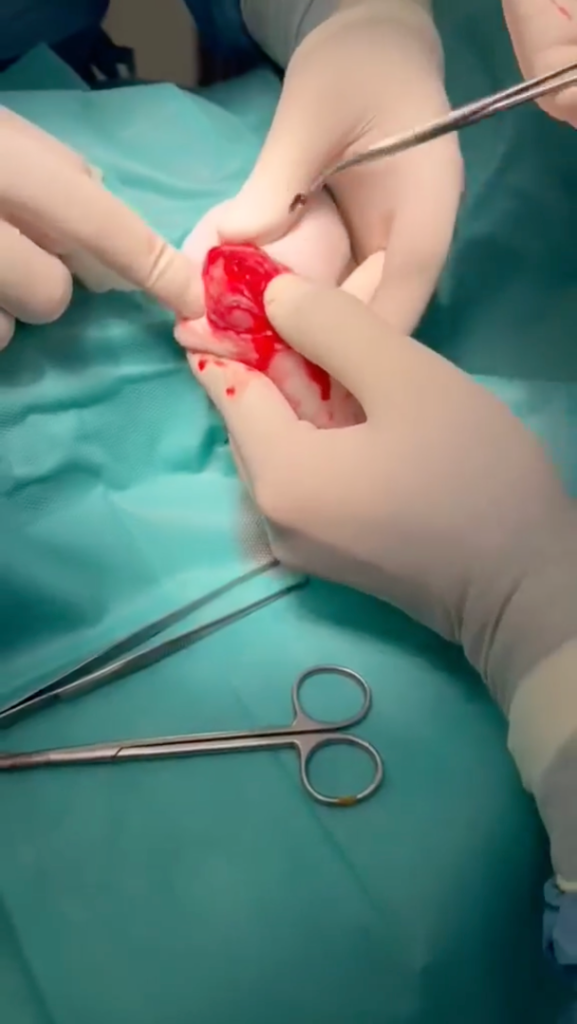Surgery Step 3